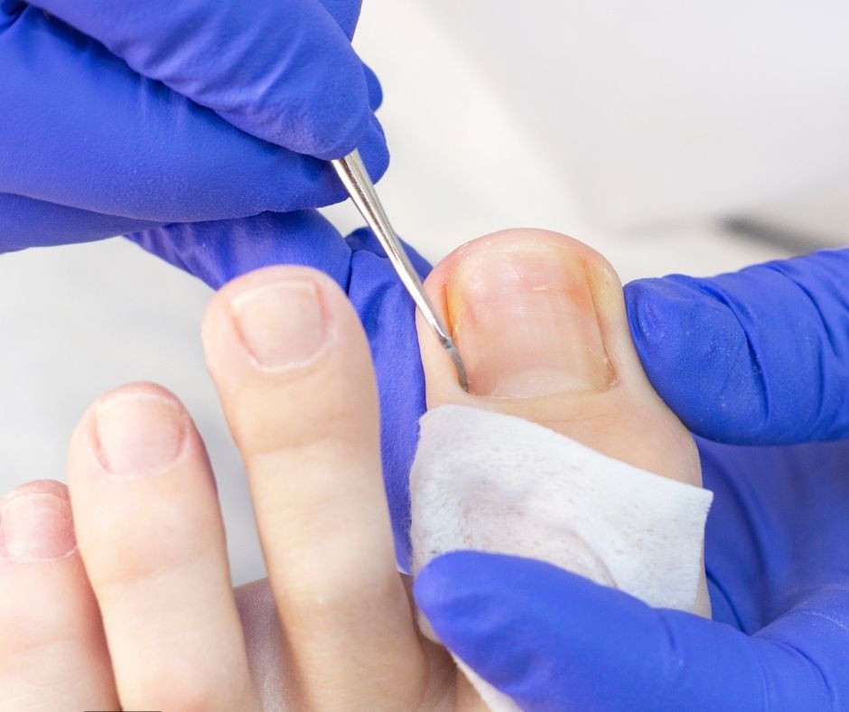 Toenail Surgery: A Complete Guide For Patients